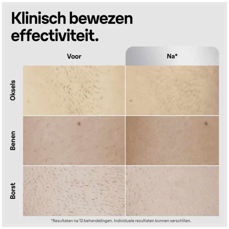 Braun IPL Silk-expert Pro 5 PL5145